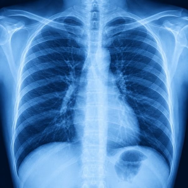 X-Ray of the Chest at Pulmonologist in Lake Town